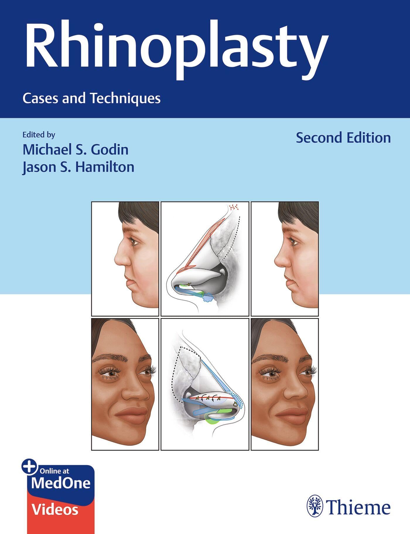 Rhinoplasty: Cases and Techniques [Hardcover] Godin, Michael S. and Hamilton, Jason S.