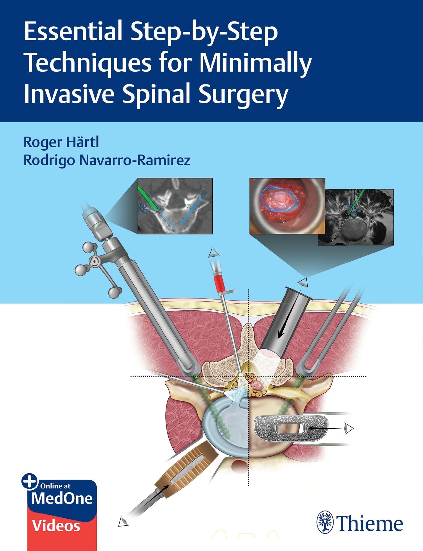Essential Step-by-Step Techniques for Minimally Invasive Spinal Surgery [Hardcover] Härtl, Roger, M.D. and Navarro-Ramirez, Rodrigo, M.D.
